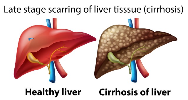 التليف-الكبدي-Liver-cirrhosis.jpg