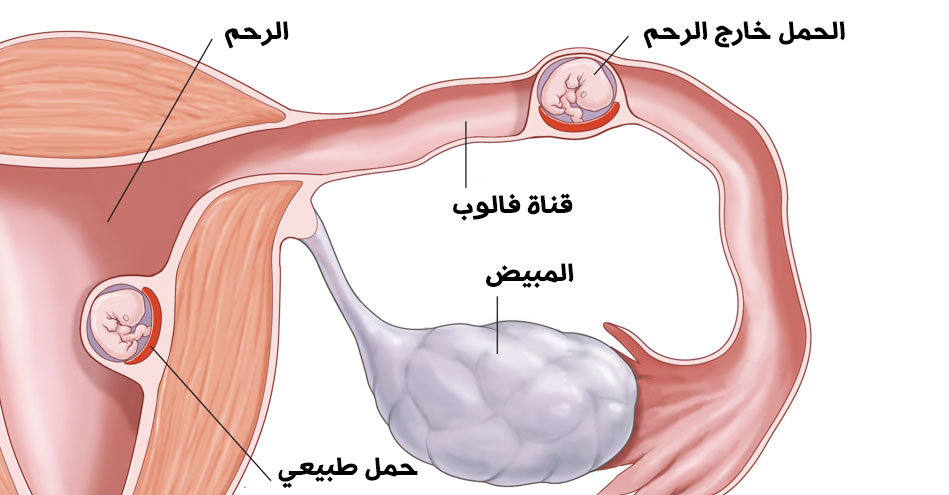 الحمل-خارج-الرحم-Ectopic-pregnancy.jpg