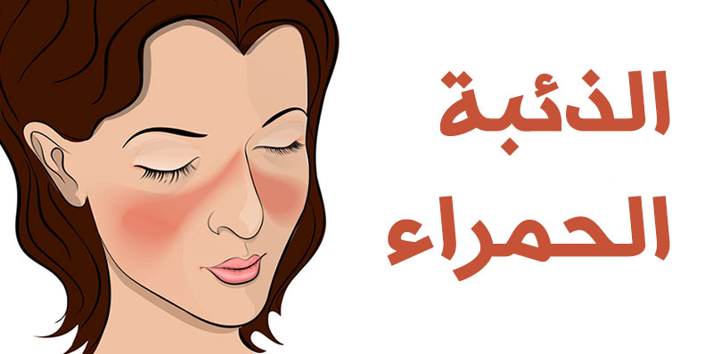 الذئبة-الحمراء.jpg