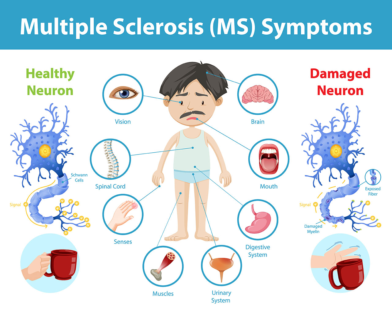 لتصلب-اللويحي-المتعدد-Multiple-sclerosis.jpg