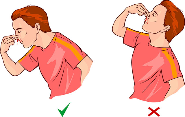 نزيف-الانف-أو-رعاف-الانف.jpg