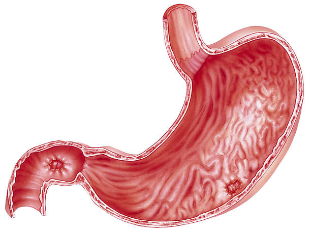 Gastric ulcer.jpg