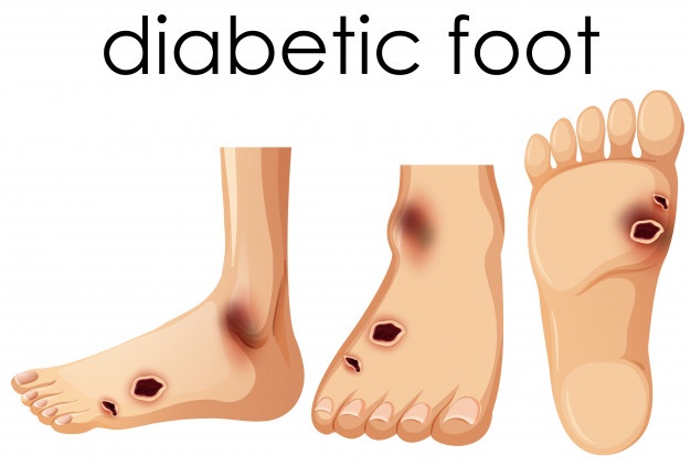 human-foot-with-diabetic.jpg