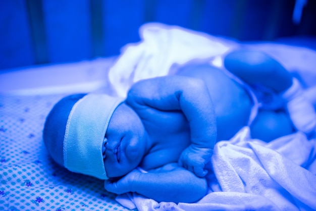 Infant-jaundice.jpg