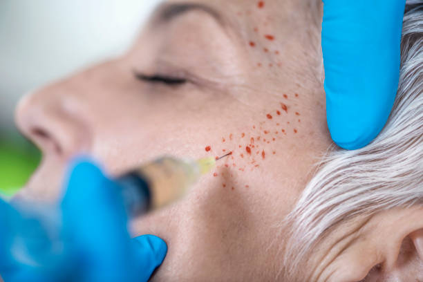 Platelet-Rich-Plasma.jpg