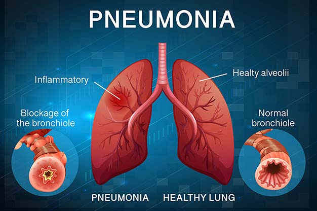 Pneumonia.jpg