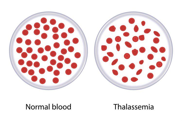 Thalassemia.png