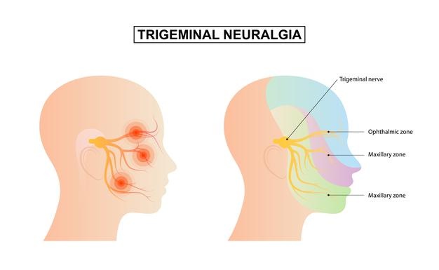 Trigeminal neuralgia.jpg