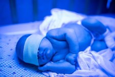 Infant-jaundice.jpg Infant-jaundice.jpg
