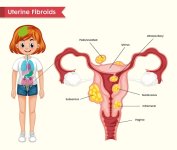 uterine-fibroids.jpg uterine-fibroids.jpg