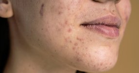 متلازمة-المبيض-متعدد-التكيسات.jpg متلازمة-المبيض-متعدد-التكيسات.jpg