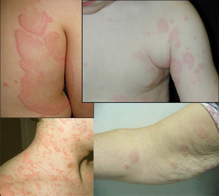 الارتيكاريا،الشرى، حساسية الجلد | Urticaria , Hives, nettle rash