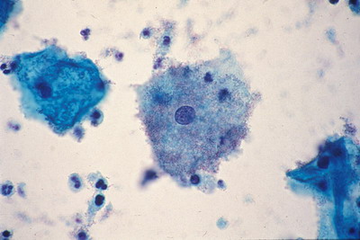 التهاب المهبل البكتيري Bacterial Vaginosis
