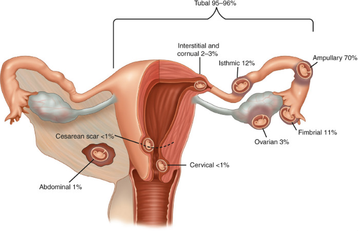 الحمل الهاجر خارج الرحم