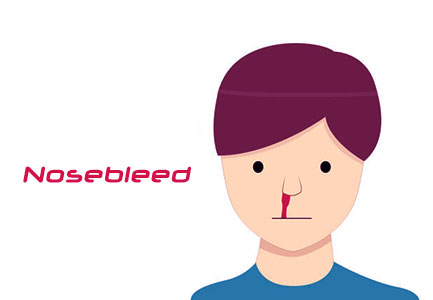 الرعاف | نزيف الانف Nosebleed Epistaxis