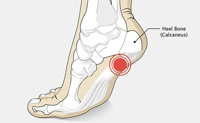 المهماز العقبي | مسمار الكعب Calcaneal spur