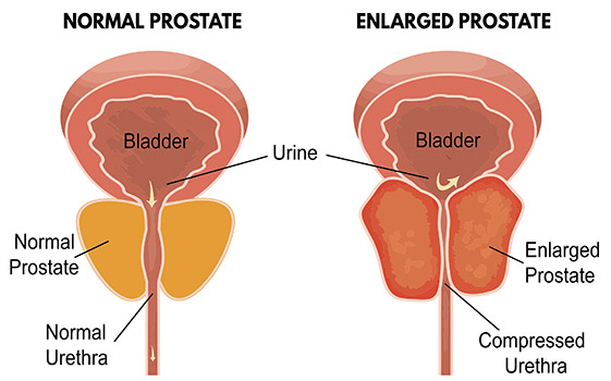 تضخم غدة البروستات Enlarged Prostate BPH