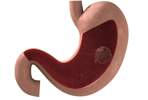 سرطان المعدة Stomach cancer