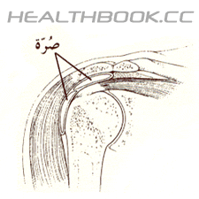 إلتهاب الصرّة