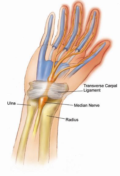 متلازمة النفق الرسغي Carpal tunnel syndrome