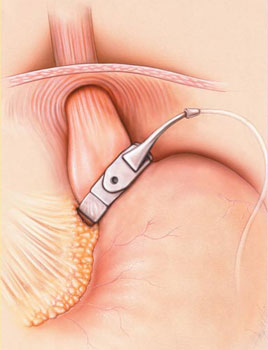 عملية جراحة ربط المعدة | حزام المعدة المتغير Adjustable gastric banding