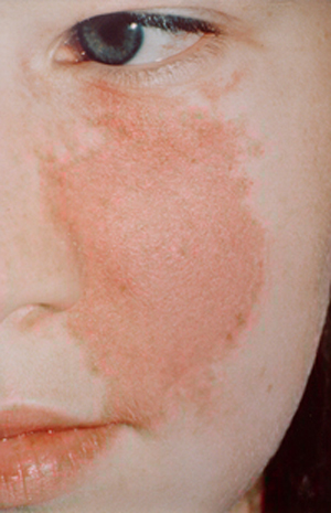 https://www.tbeeb.net/ph/files/1/health_topics/Birthmarks.jpg