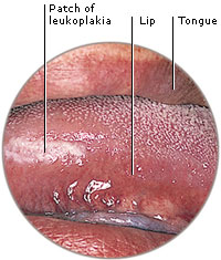 سرطان الفم وما قبله | أورام الفم والشفتين | الوقاية من سرطان الفم واللسان