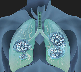 سرطان الرئة Lung Cancer