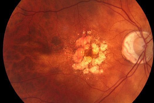 التنكس البقعي | Macular degeneration