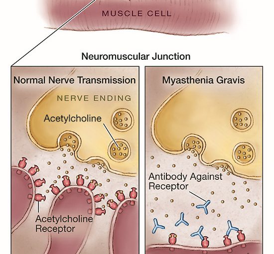 الوهن العضلي الشديد Myasthenia Gravis