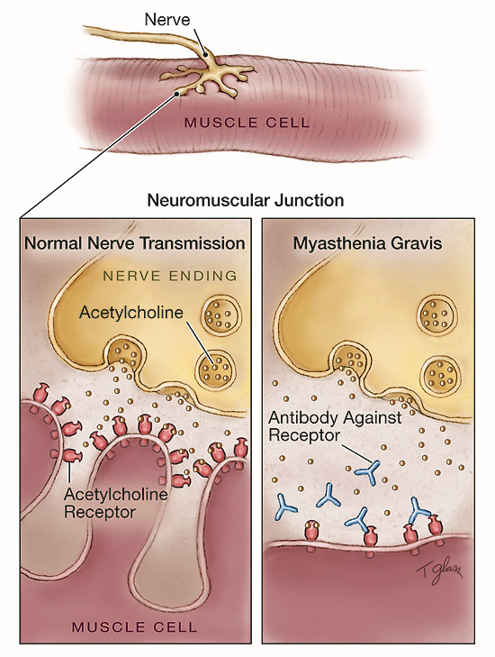 الوهن العضلي الشديد Myasthenia Gravis