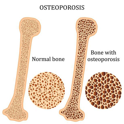 هشاشة العظام | ترقق العظم Osteoporosis