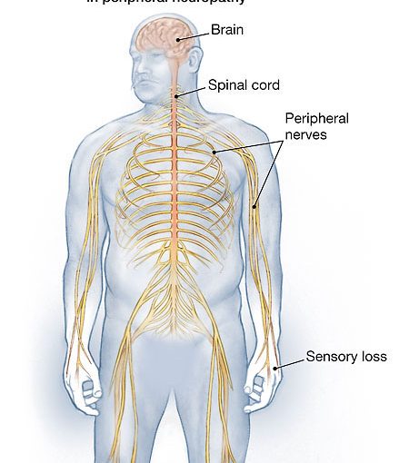 الاعتلال العصبي الطرفي | اعتلال الأعصاب Peripheral Neuropathy