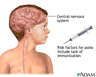 شلل الأطفال Poliomyelitis