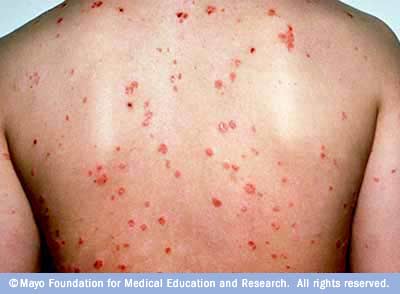 الصدفية Psoriasis إلى أين ؟