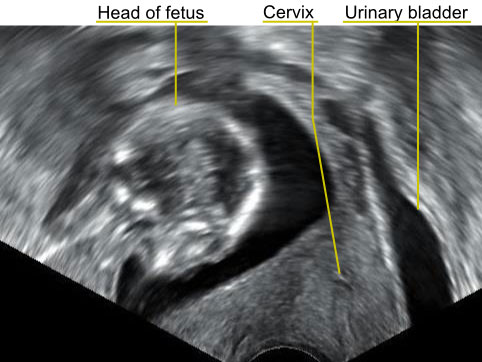 ميلان أو انقلاب الرحم، انكفاء الرحم الى الخلف، الرحم المنقلب للخلف Retroverted Uterus