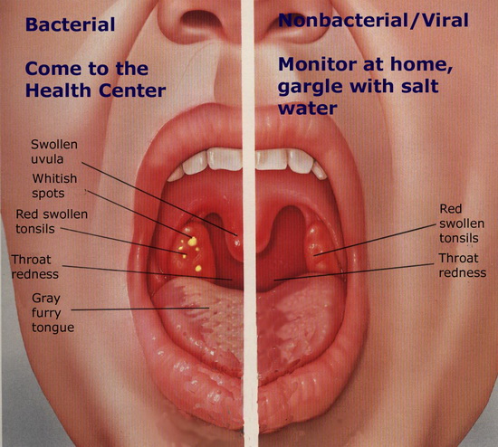 التهاب اللوزتين | الأعراض، التشخيص، الأسباب، العلاج Tonsillitis