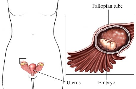 ‏الحمل خارج الرحم Ectopic Pregnancy