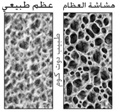 ‏هشاشة العظام، ترقق العظام Osteoporosis