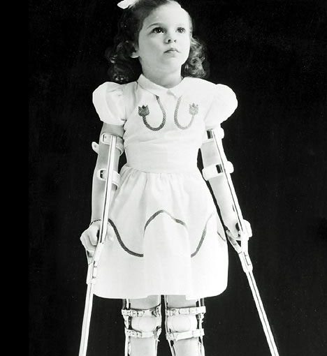 ‏شلل الأطفال | متلازمة ما بعد الشلل Polio and Postpolio Syndrome