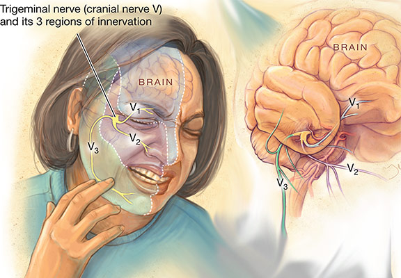 ألم عصبي Neuralgia