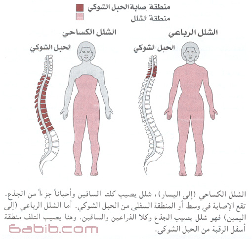 إصابات الحبل الشوكي Spinal Cord Injuries