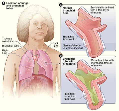 الالتهاب-الشعبي-الحاد-Acute-bronchitis