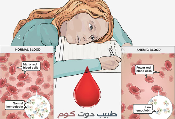 الانيميا أو فقر الدم Anemia