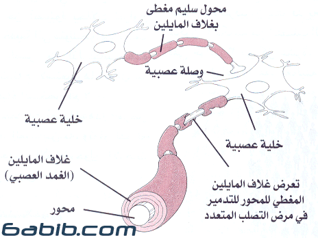 التصلب المتعدد