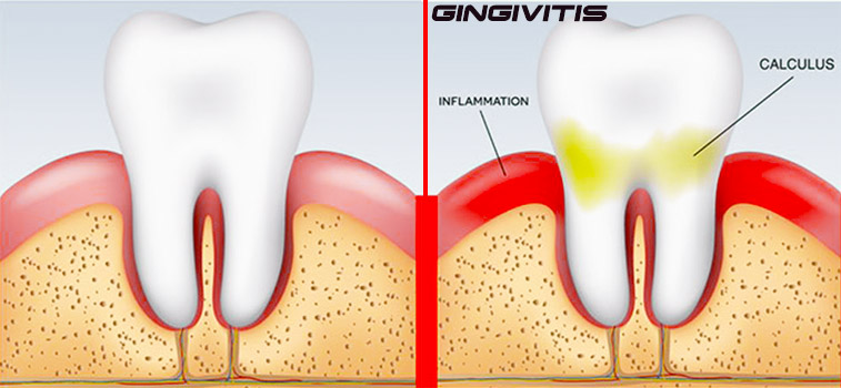 التهاب اللثة | إلتهاب النسيج المحيط بالأسنان
