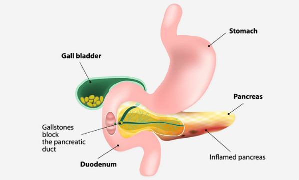 التهاب البنكرياس الحاد Acute Pancreatitis