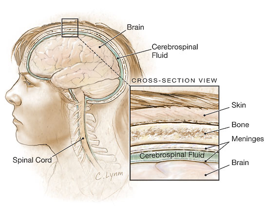 JAMA Patient Page | Meningitis