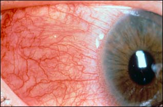 التهاب الصلبة و ما فوق الصلبة scleritis