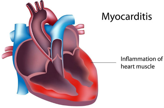 التهاب العضلة القلبية | التهاب عضل القلب Myocarditis